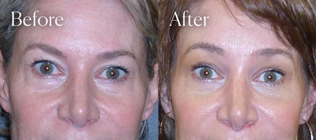 Brow Lift result at Shah Aesthetic Surgery - Rhinoplasty and Facelift Specialist in Englewood, CO