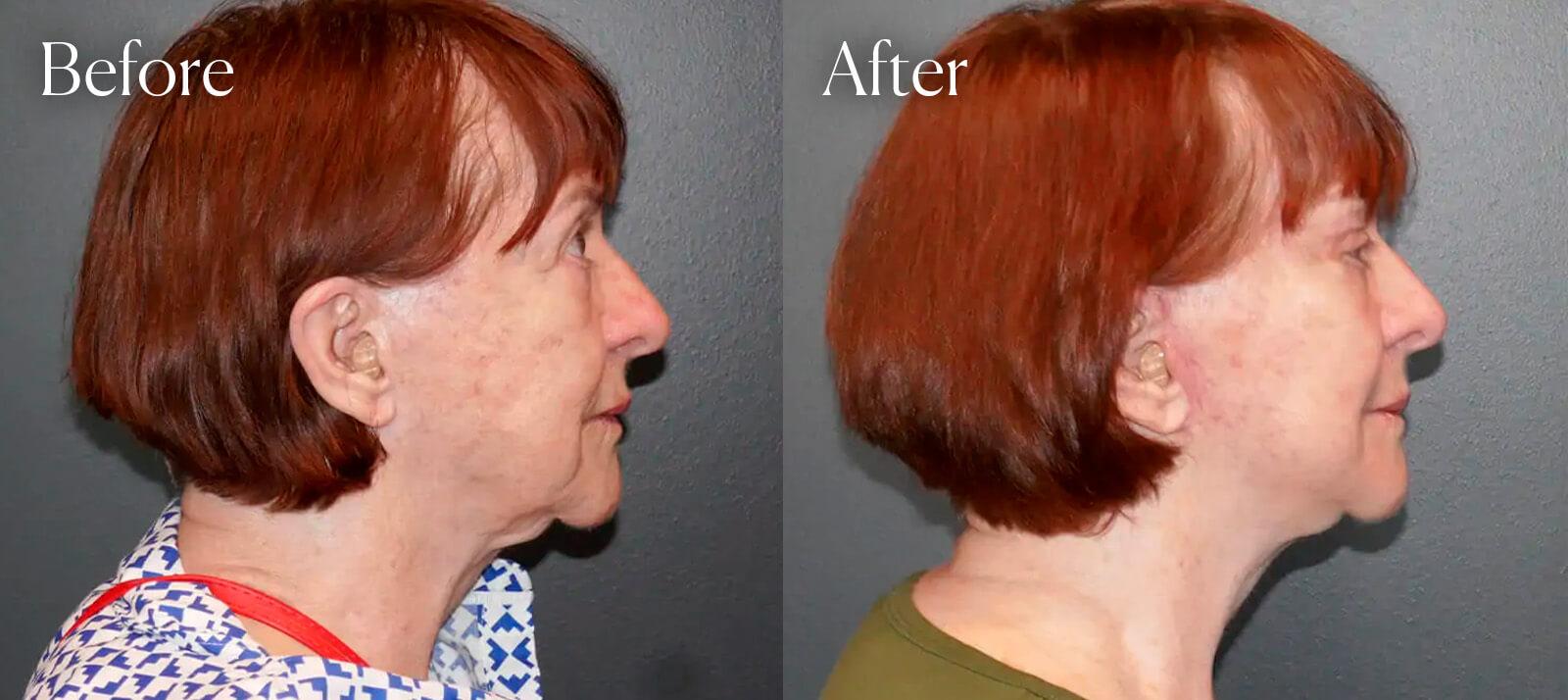 Shah Aesthetic Surgery - Rhinoplasty and Facelift Specialist result — Englewood, CO