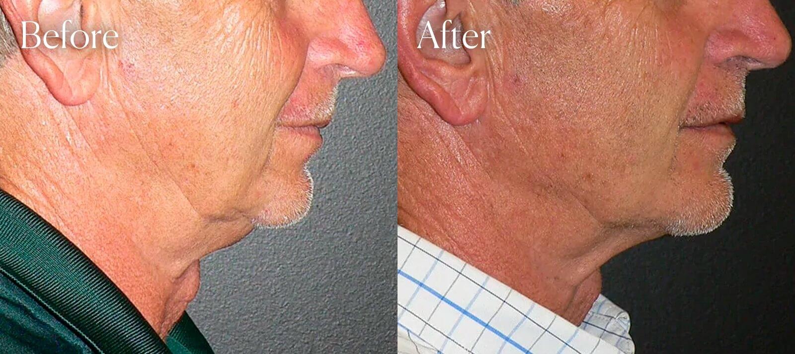 Shah Aesthetic Surgery - Rhinoplasty and Facelift Specialist chin implant result — Englewood, CO