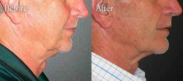 Chin Implant result at Shah Aesthetic Surgery - Rhinoplasty and Facelift Specialist in Englewood, CO