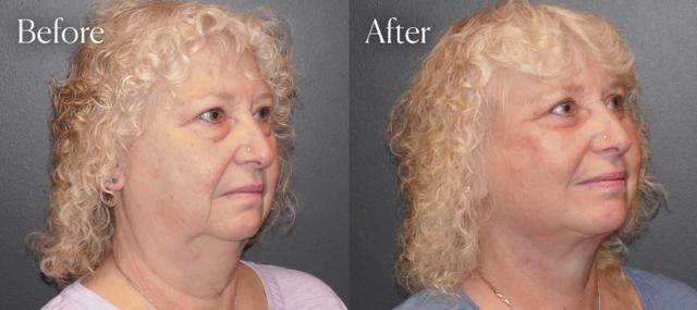 Blepharoplasty result at Shah Aesthetic Surgery - Rhinoplasty and Facelift Specialist in Englewood, CO