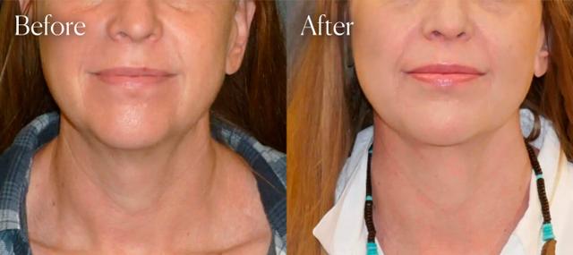Neck Lift result at Shah Aesthetic Surgery - Rhinoplasty and Facelift Specialist in Englewood, CO