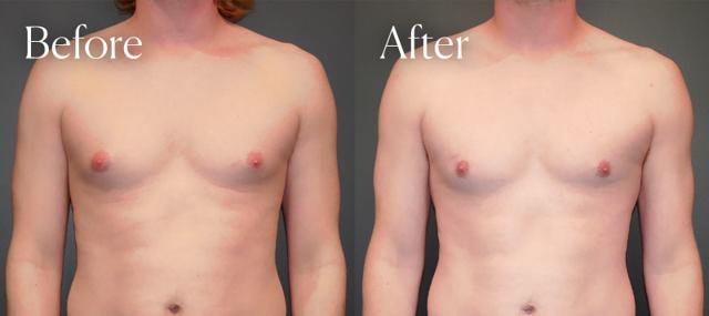 Gynecomastia Surgery result at Shah Aesthetic Surgery - Rhinoplasty and Facelift Specialist in Englewood, CO