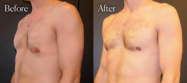 Gynecomastia Surgery result at Shah Aesthetic Surgery - Rhinoplasty and Facelift Specialist in Englewood, CO