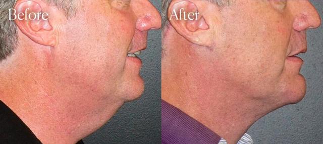 Neck Lift result at Shah Aesthetic Surgery - Rhinoplasty and Facelift Specialist in Englewood, CO