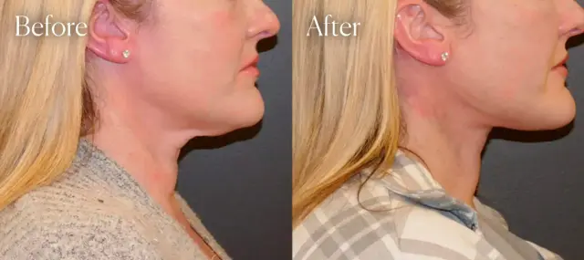 Neck Lift result at Shah Aesthetic Surgery - Rhinoplasty and Facelift Specialist in Englewood, CO