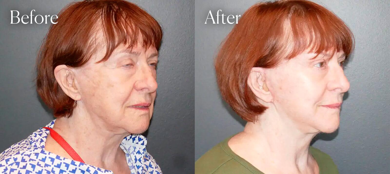 Shah Aesthetic Surgery - Rhinoplasty and Facelift Specialist result — Englewood, CO