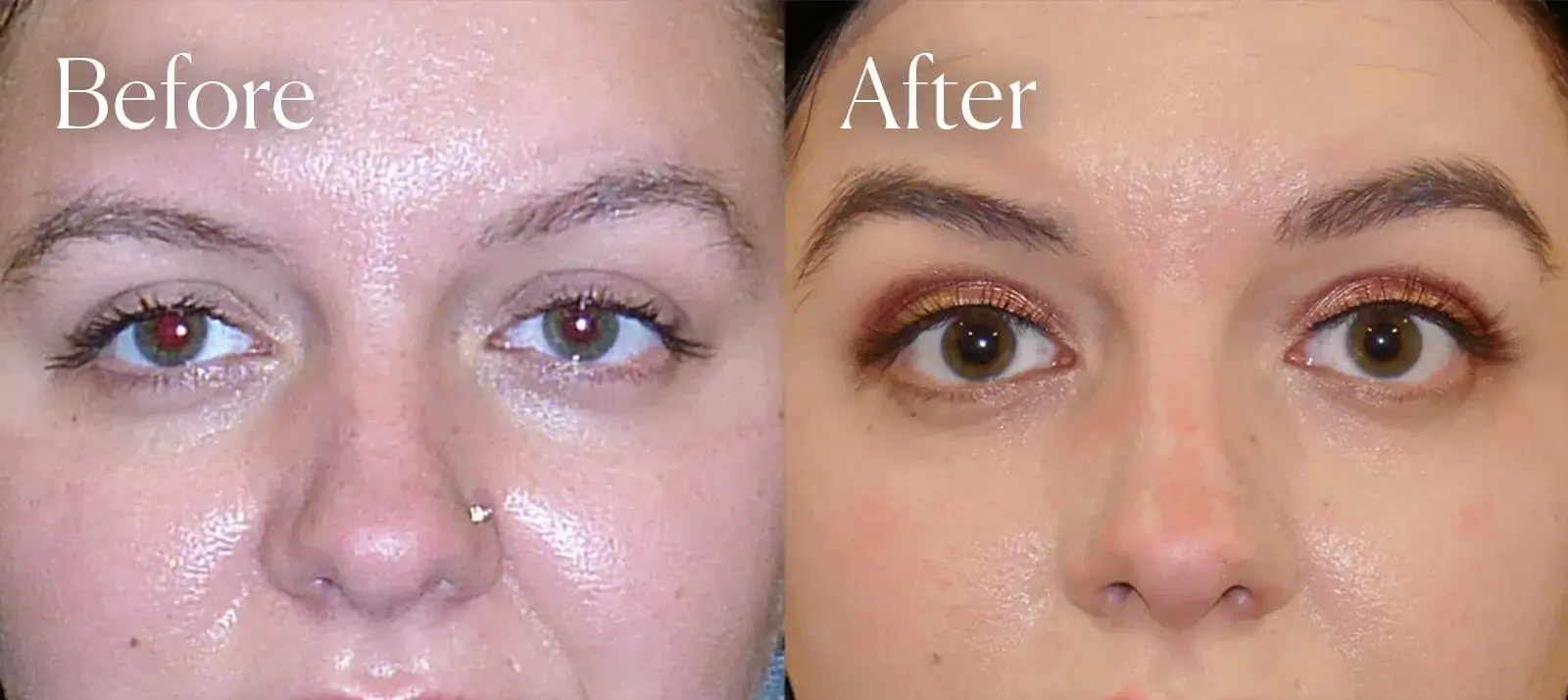 Shah Aesthetic Surgery - Rhinoplasty and Facelift Specialist brow lift result — Englewood, CO