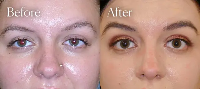 Brow Lift result at Shah Aesthetic Surgery - Rhinoplasty and Facelift Specialist in Englewood, CO