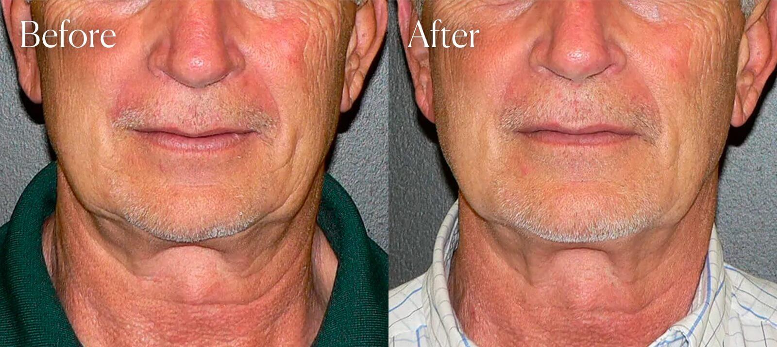 Shah Aesthetic Surgery - Rhinoplasty and Facelift Specialist chin implant result — Englewood, CO