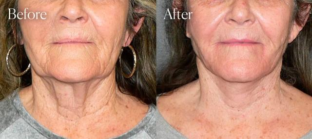 Neck Lift result at Shah Aesthetic Surgery - Rhinoplasty and Facelift Specialist in Englewood, CO
