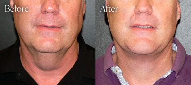 Neck Lift result at Shah Aesthetic Surgery - Rhinoplasty and Facelift Specialist in Englewood, CO