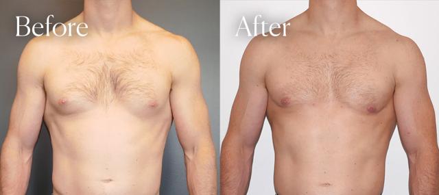 Gynecomastia Surgery result at Shah Aesthetic Surgery - Rhinoplasty and Facelift Specialist in Englewood, CO