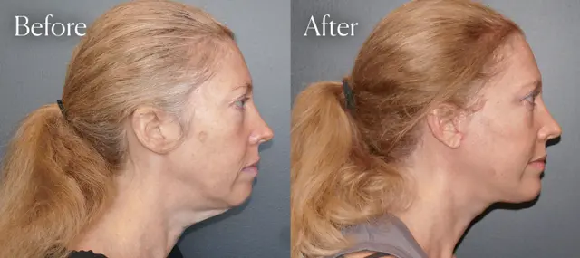 Blepharoplasty result at Shah Aesthetic Surgery - Rhinoplasty and Facelift Specialist in Englewood, CO