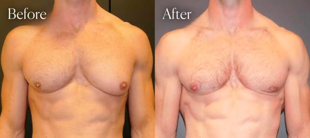 Gynecomastia Surgery result at Shah Aesthetic Surgery - Rhinoplasty and Facelift Specialist in Englewood, CO