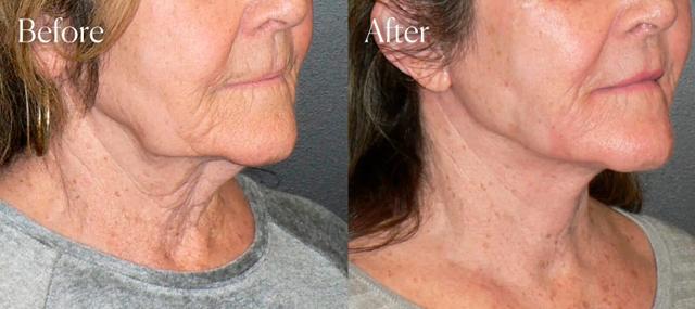 Neck Lift result at Shah Aesthetic Surgery - Rhinoplasty and Facelift Specialist in Englewood, CO