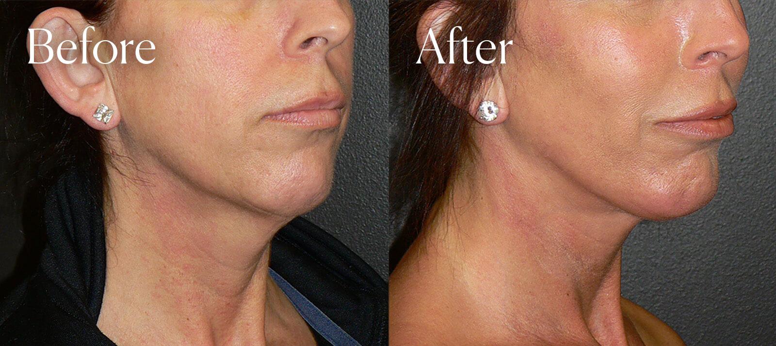 Shah Aesthetic Surgery - Rhinoplasty and Facelift Specialist chin implant result — Englewood, CO