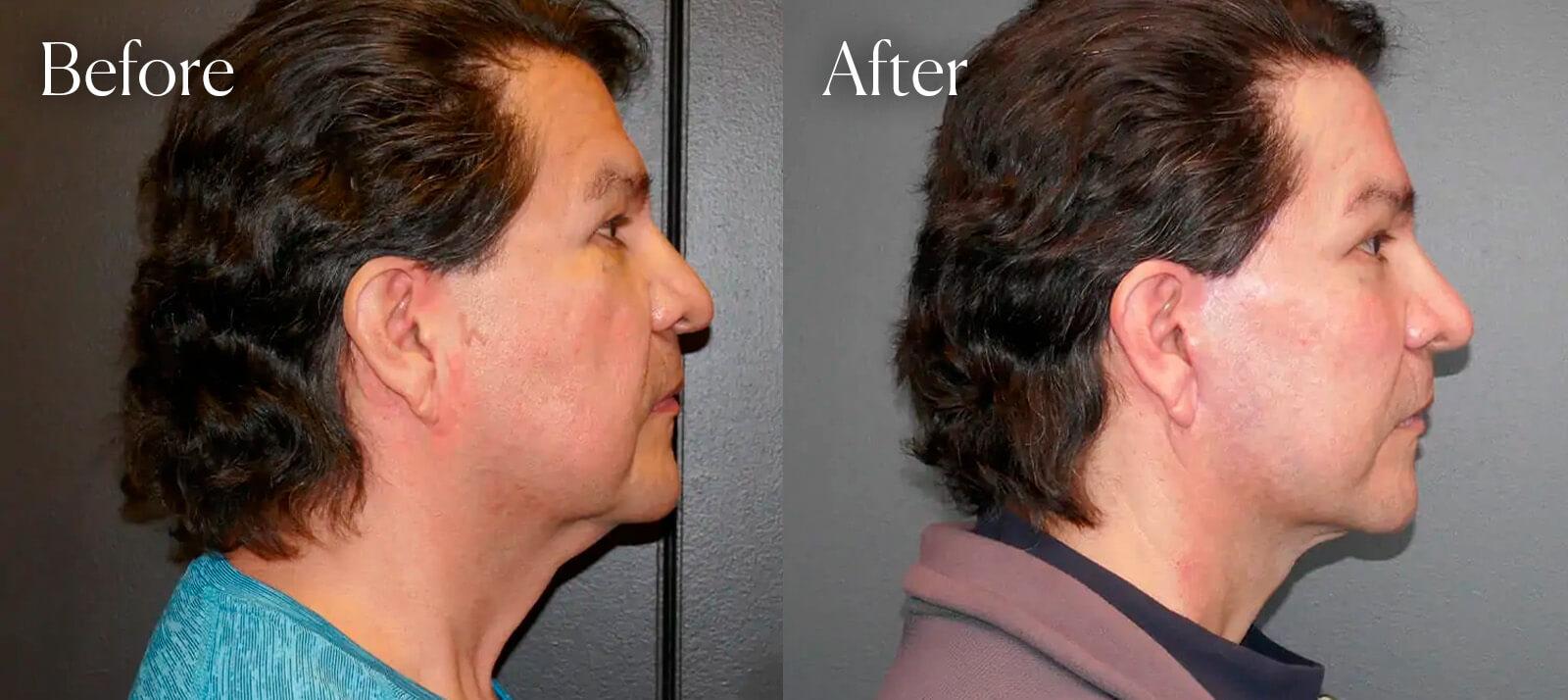 Shah Aesthetic Surgery - Rhinoplasty and Facelift Specialist facelift result — Englewood, CO