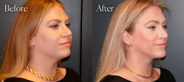 Rhinoplasty result at Shah Aesthetic Surgery - Rhinoplasty and Facelift Specialist in Englewood, CO
