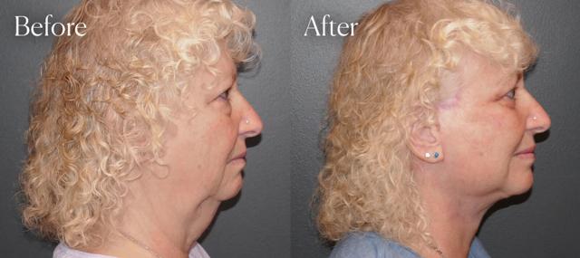 Blepharoplasty result at Shah Aesthetic Surgery - Rhinoplasty and Facelift Specialist in Englewood, CO