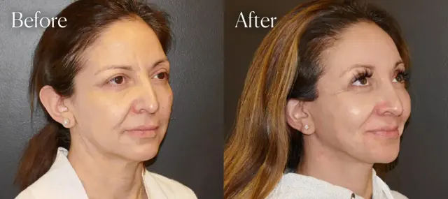 Facelift after at Shah Aesthetic Surgery - Rhinoplasty and Facelift Specialist in Englewood, CO