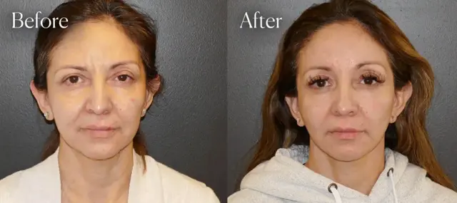 Facelift before at Shah Aesthetic Surgery - Rhinoplasty and Facelift Specialist in Englewood, CO