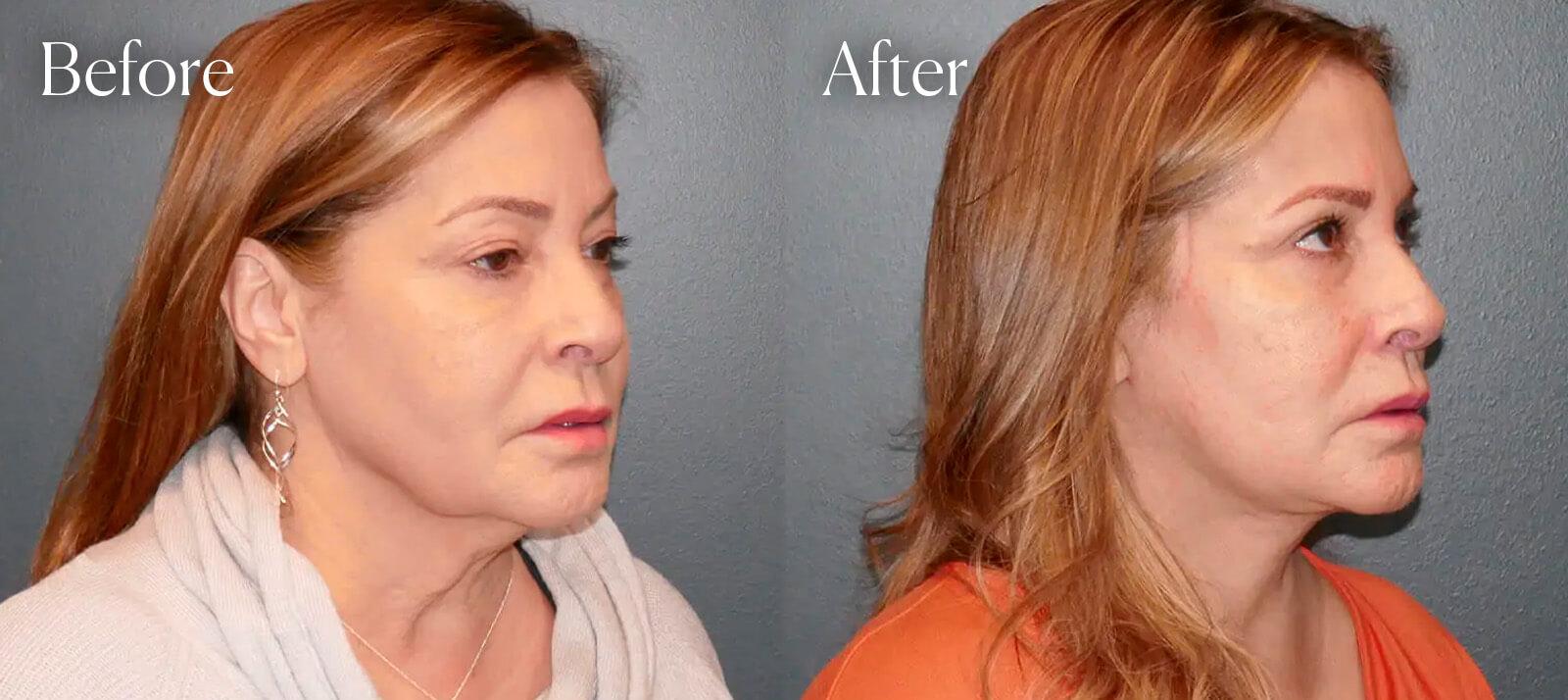 Shah Aesthetic Surgery - Rhinoplasty and Facelift Specialist facelift result — Englewood, CO