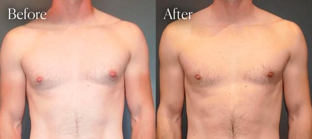 Gynecomastia Surgery result at Shah Aesthetic Surgery - Rhinoplasty and Facelift Specialist in Englewood, CO