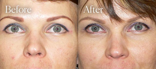 Brow Lift result at Shah Aesthetic Surgery - Rhinoplasty and Facelift Specialist in Englewood, CO
