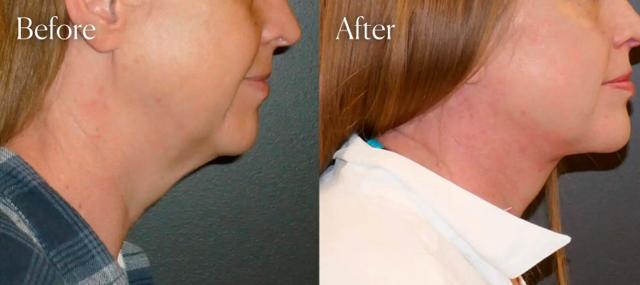 Neck Lift result at Shah Aesthetic Surgery - Rhinoplasty and Facelift Specialist in Englewood, CO