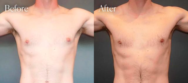 Gynecomastia Surgery result at Shah Aesthetic Surgery - Rhinoplasty and Facelift Specialist in Englewood, CO