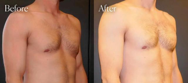 Gynecomastia Surgery result at Shah Aesthetic Surgery - Rhinoplasty and Facelift Specialist in Englewood, CO