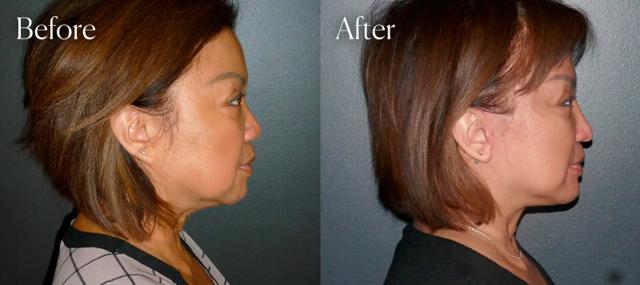 Rhinoplasty result at Shah Aesthetic Surgery - Rhinoplasty and Facelift Specialist in Englewood, CO