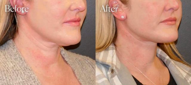 Neck Lift result at Shah Aesthetic Surgery - Rhinoplasty and Facelift Specialist in Englewood, CO