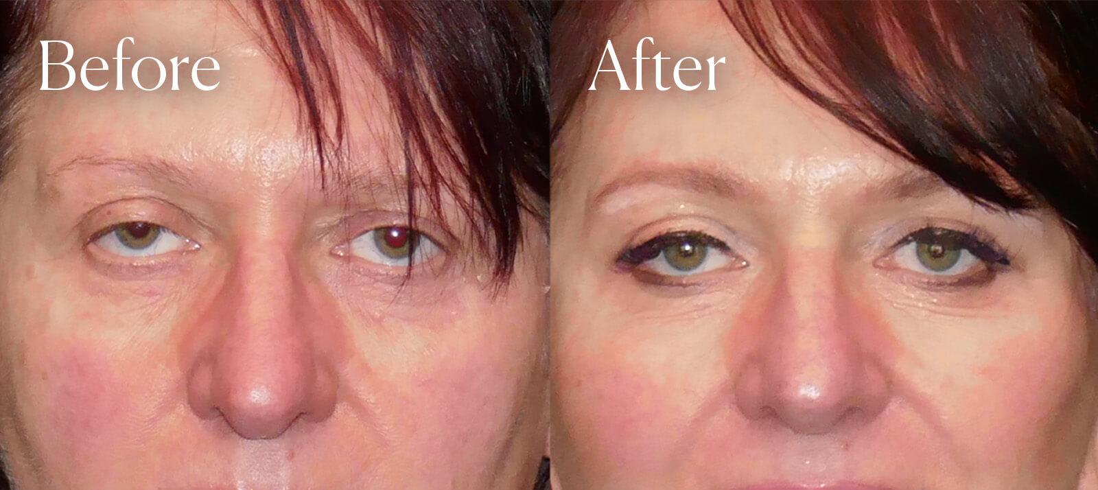 Shah Aesthetic Surgery - Rhinoplasty and Facelift Specialist brow lift result — Englewood, CO