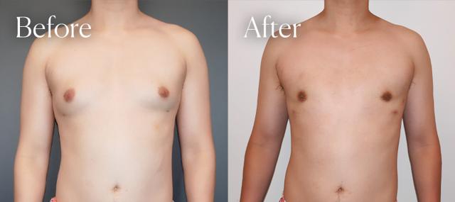 Gynecomastia Surgery result at Shah Aesthetic Surgery - Rhinoplasty and Facelift Specialist in Englewood, CO