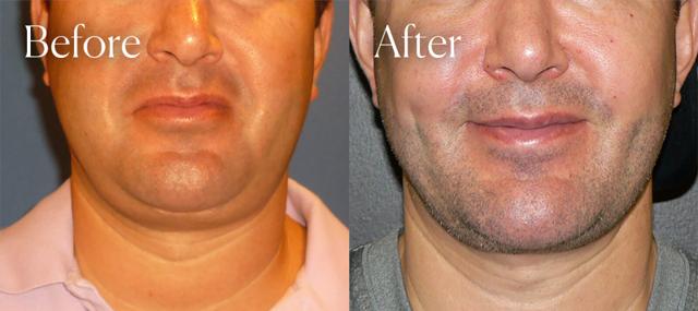 Neck Liposuction result at Shah Aesthetic Surgery - Rhinoplasty and Facelift Specialist in Englewood, CO