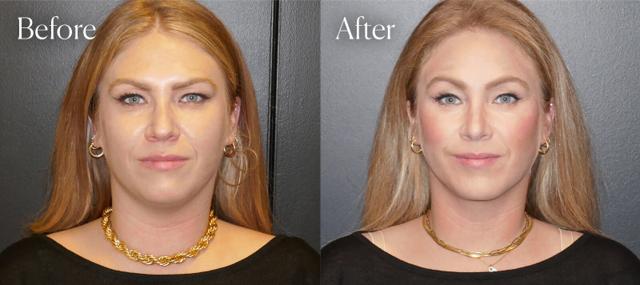 Rhinoplasty result at Shah Aesthetic Surgery - Rhinoplasty and Facelift Specialist in Englewood, CO