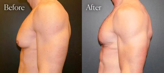 Gynecomastia Surgery result at Shah Aesthetic Surgery - Rhinoplasty and Facelift Specialist in Englewood, CO
