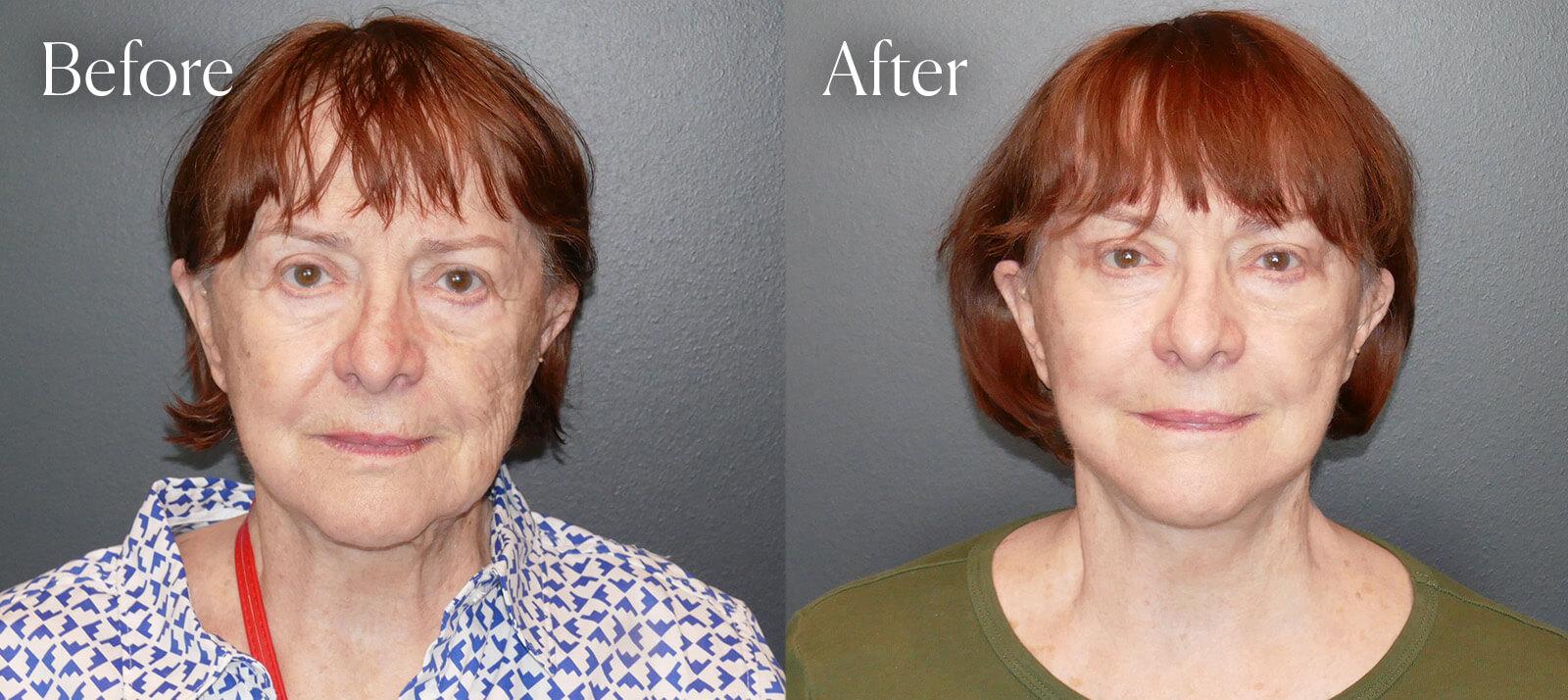 Shah Aesthetic Surgery - Rhinoplasty and Facelift Specialist result — Englewood, CO