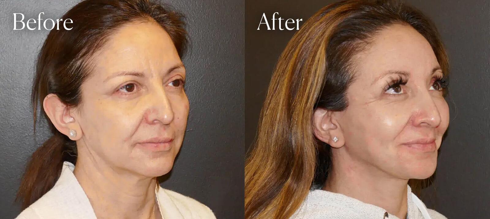 Shah Aesthetic Surgery - Rhinoplasty and Facelift Specialist facelift after — Englewood, CO