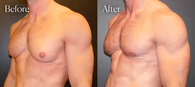 Gynecomastia Surgery result at Shah Aesthetic Surgery - Rhinoplasty and Facelift Specialist in Englewood, CO