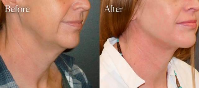 Neck Lift result at Shah Aesthetic Surgery - Rhinoplasty and Facelift Specialist in Englewood, CO