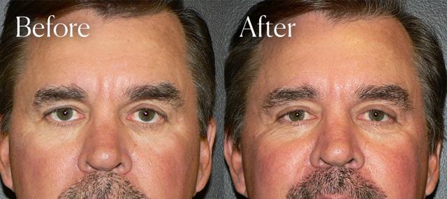 Botox result at Shah Aesthetic Surgery - Rhinoplasty and Facelift Specialist in Englewood, CO