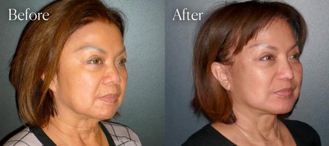 Rhinoplasty result at Shah Aesthetic Surgery - Rhinoplasty and Facelift Specialist in Englewood, CO