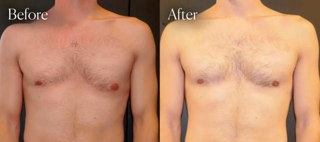 Gynecomastia Surgery result at Shah Aesthetic Surgery - Rhinoplasty and Facelift Specialist in Englewood, CO