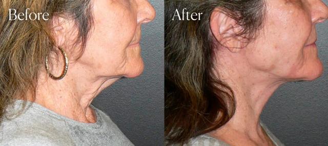 Neck Lift result at Shah Aesthetic Surgery - Rhinoplasty and Facelift Specialist in Englewood, CO