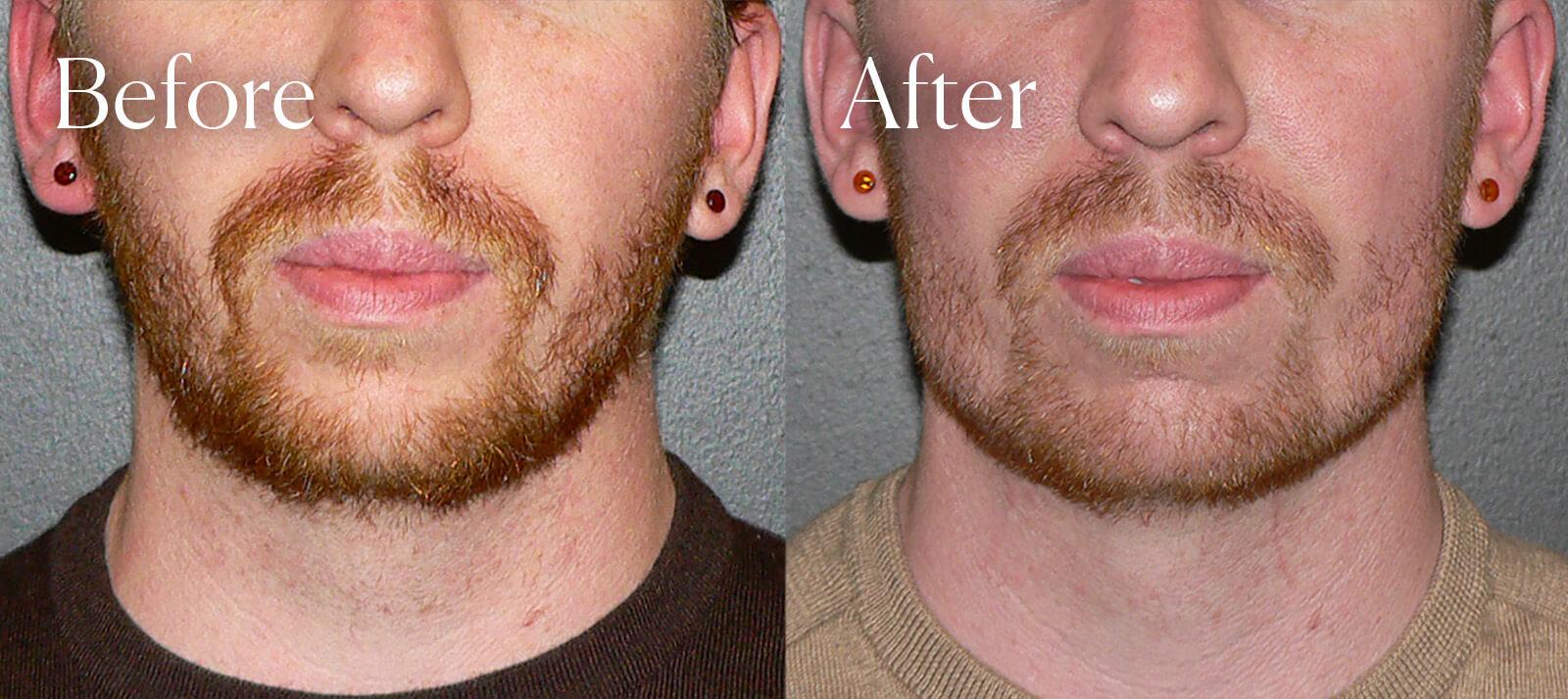 Shah Aesthetic Surgery - Rhinoplasty and Facelift Specialist chin implant result — Englewood, CO