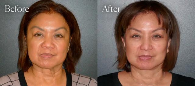 Rhinoplasty result at Shah Aesthetic Surgery - Rhinoplasty and Facelift Specialist in Englewood, CO