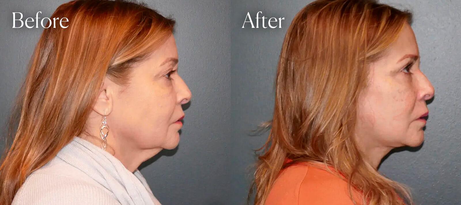 Shah Aesthetic Surgery - Rhinoplasty and Facelift Specialist facelift result — Englewood, CO